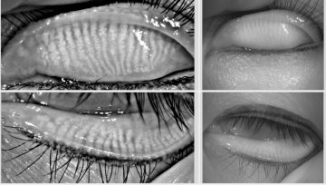 這個“殺手”有點兇殘,是(shì)幹眼常見(jiàn)的病因!