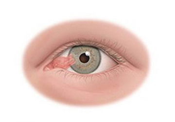 奇怪了，眼睛裏多長了一塊肉